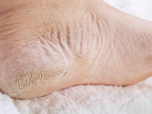 از علت تا درمان ترک پا | سه تا کالا